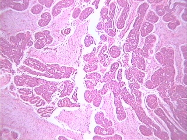 Fig. 2   Hiperplasia epitelial en un phyllodes - <div style=